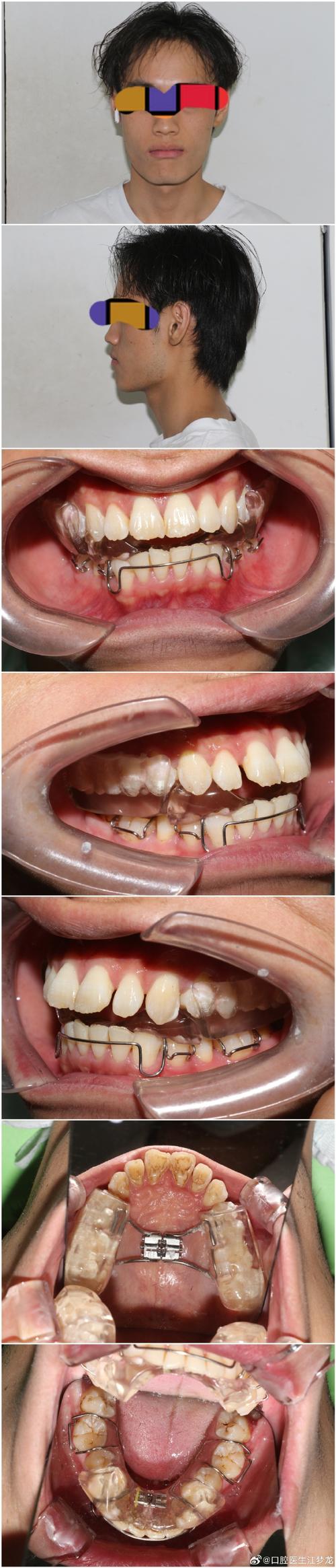 牙板固定之后正畸-图2