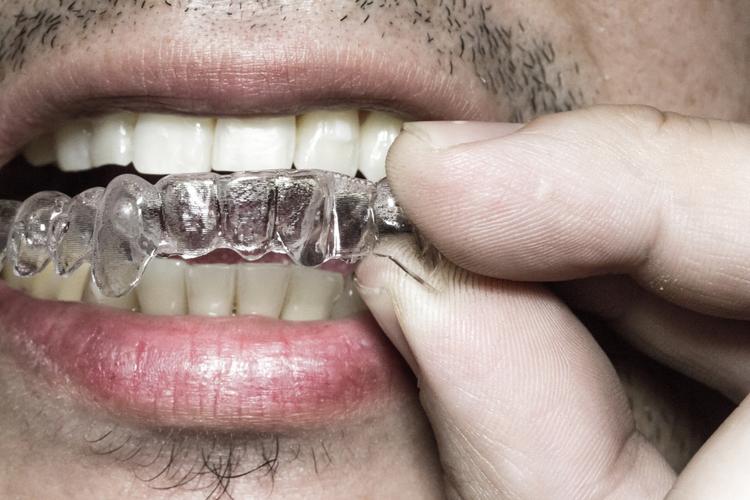 常州隐形透明正畸-图1