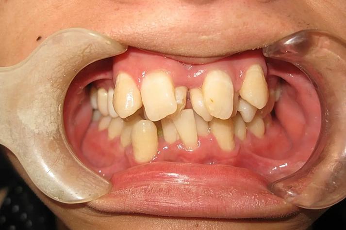 牙齿稀疏正畸失败-图1