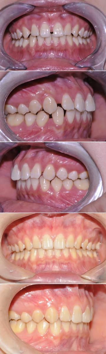 牙齿稀疏正畸失败-图2