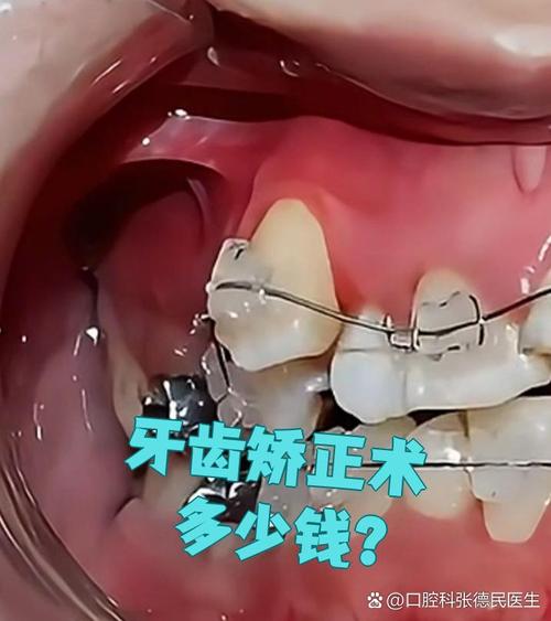 牙床高低正畸手术-图1