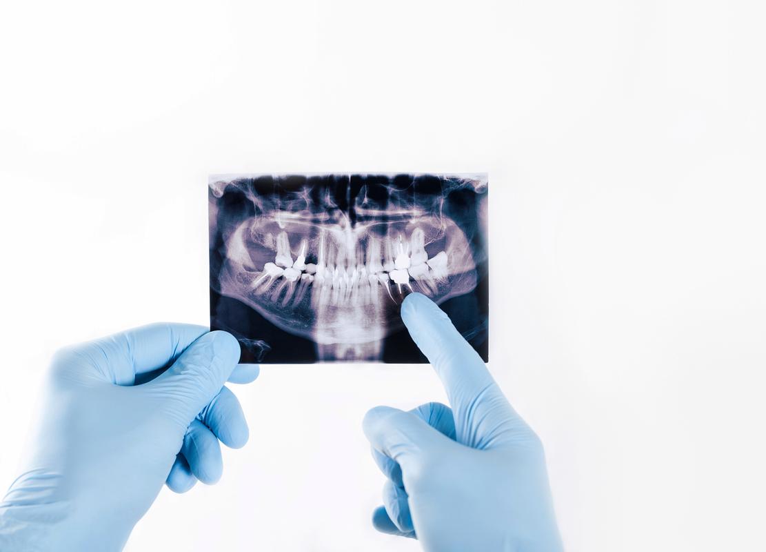 数字隐形正畸,如何兼顾美观与矫正效果?-图2 数字隐形正畸,如何兼顾美观与矫正效果?-图2