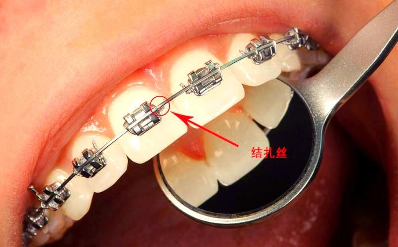 正畸主动结扎怎么操作？视频演示教你掌握步骤-图1