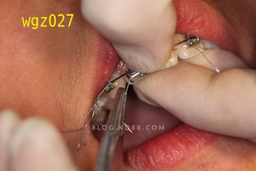正畸主动结扎怎么操作？视频演示教你掌握步骤-图2
