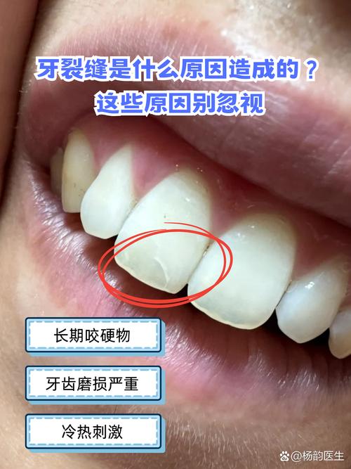 正畸期间牙齿裂开-图1 正畸期间牙齿裂开-图1