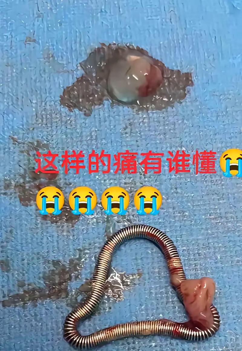 正畸牙齿带环掉了-图1