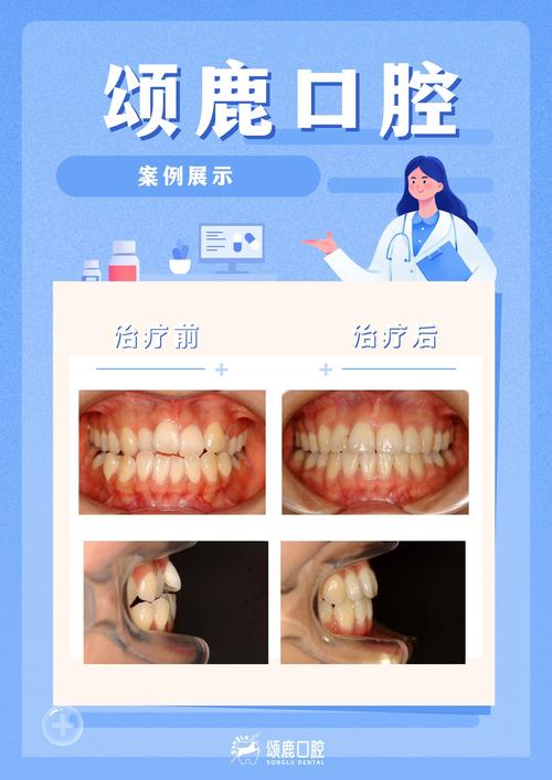 正畸牙医分享案例-图1 正畸牙医分享案例-图1