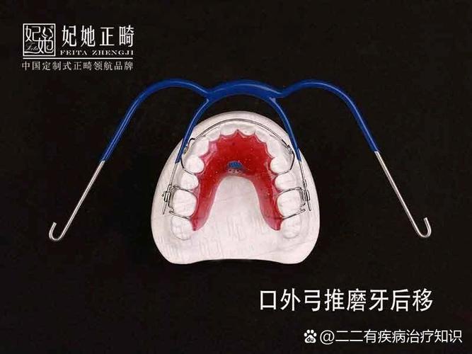 正畸如何移动磨牙？原理与方法是什么？-图1