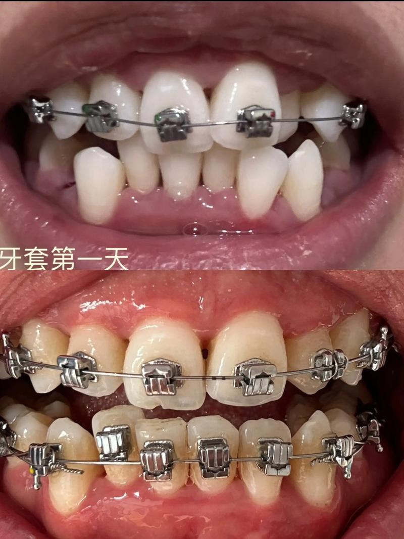 正畸矫正牙齿,过程中牙齿会有什么感受?-图2 正畸矫正牙齿,过程中牙齿会有什么感受?-图2