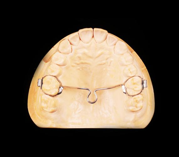 正畸里tpa作用-图2