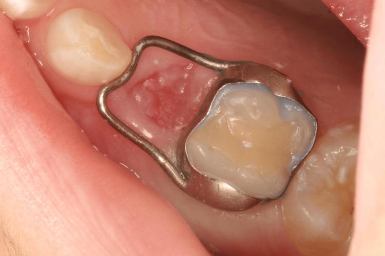 口腔正畸间隙关闭-图1 口腔正畸间隙关闭-图1