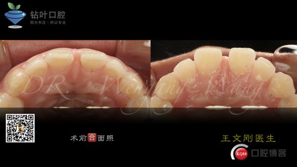 口腔正畸间隙关闭-图2 口腔正畸间隙关闭-图2