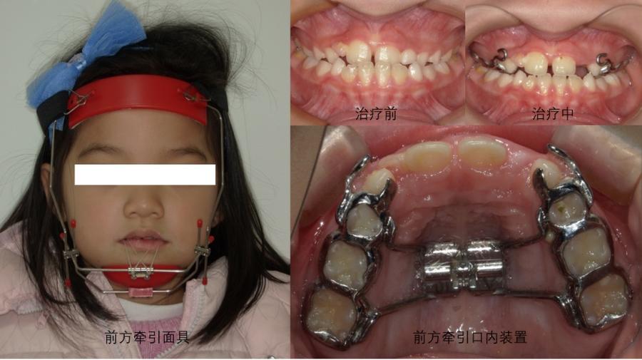 正畸常见牵引方式-图3 正畸常见牵引方式-图3