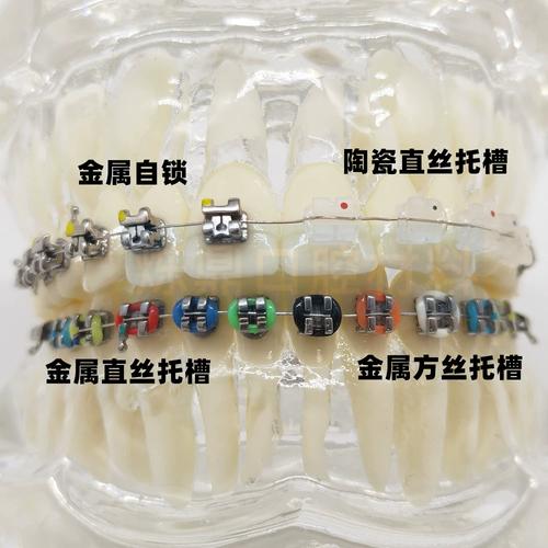 正畸金属托槽复诊-图2