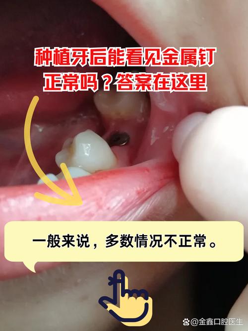 正畸种植钉 出血-图2