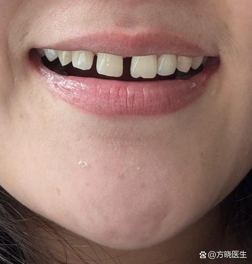 正畸完 后 牙缝-图2