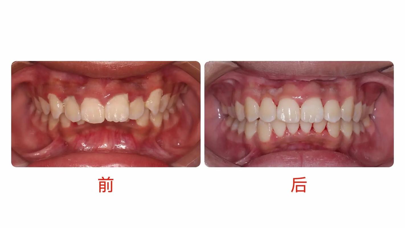 正畸优秀病例分享-图2 正畸优秀病例分享-图2