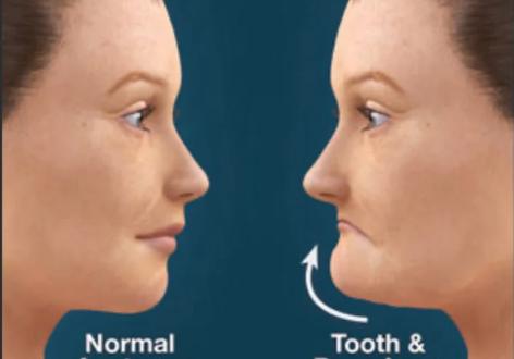 成都LH正畸法效果如何？适合哪些牙齿矫正需求？-图1