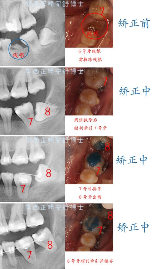 成都LH正畸法效果如何？适合哪些牙齿矫正需求？-图3