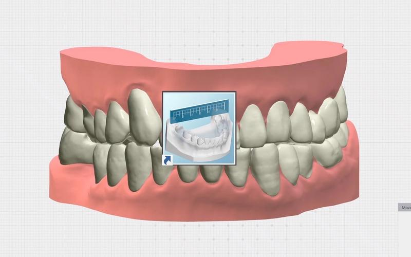 正畸主流设计软件-图3