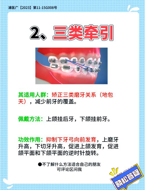 正畸颌间牵引定义-图1