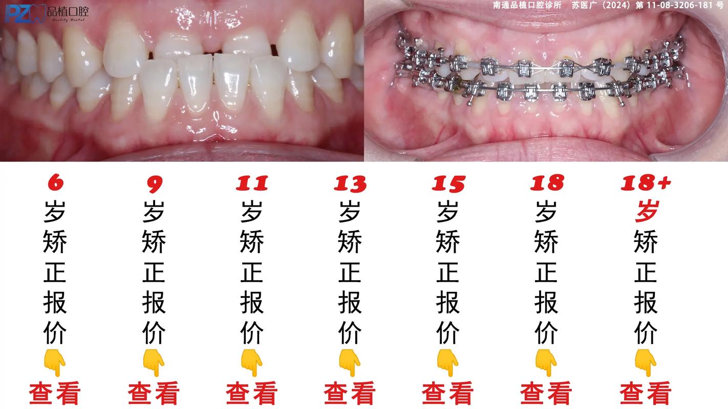 正畸中牙齿宽度测量为何是矫正的关键环节?-图3 正畸中牙齿宽度测量为何是矫正的关键环节?-图3
