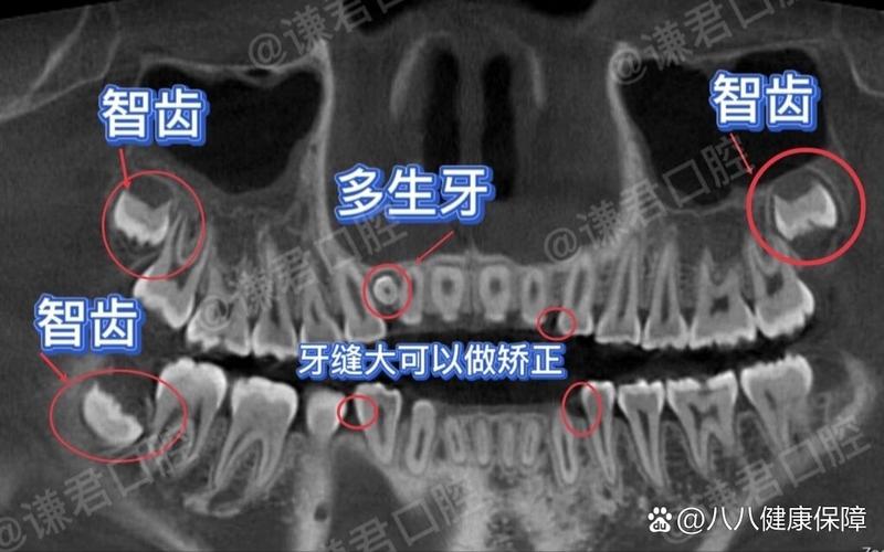 牙齿正畸拍片为何必要？包含哪些关键检查？-图3