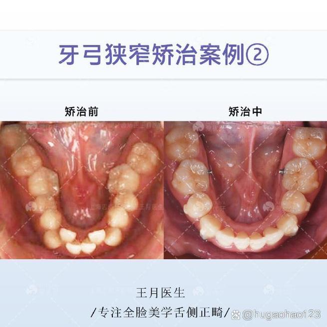 正畸导致牙弓狭窄-图1 正畸导致牙弓狭窄-图1