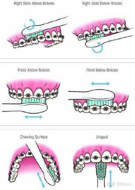 正畸患者戴牙套，刷牙的正确方法是什么？-图2