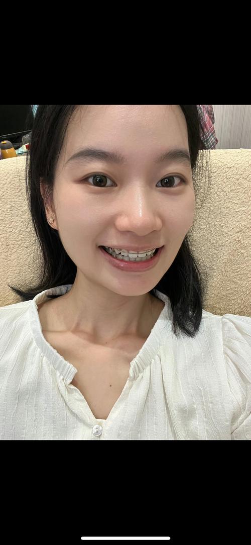 正畸 结束后照片-图1