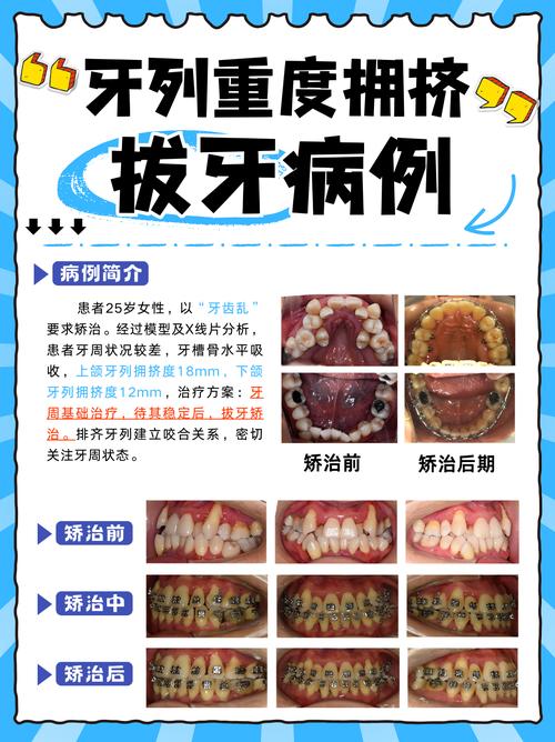 前牙拥挤正畸病例-图2