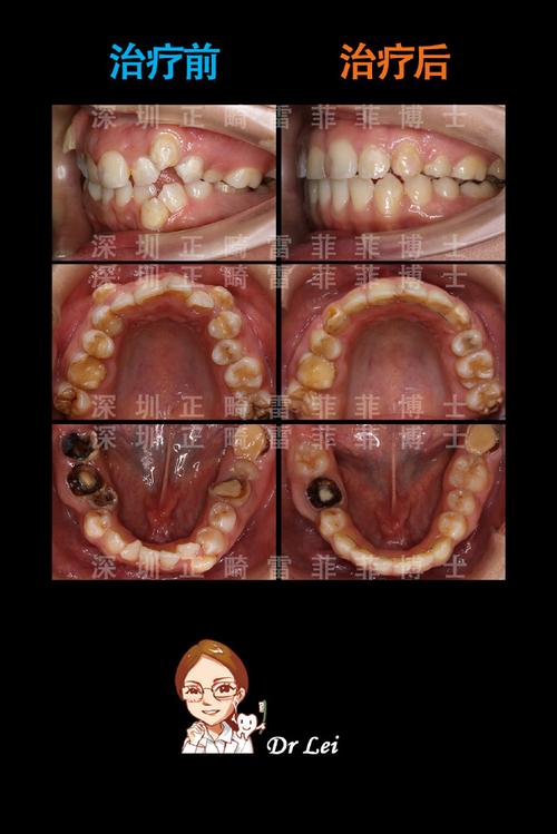 前牙拥挤正畸病例-图3