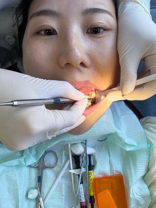 正畸科补牙？矫正期间能同时补牙吗？-图2