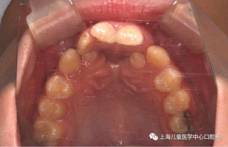 口腔正畸 唇腭裂-图1