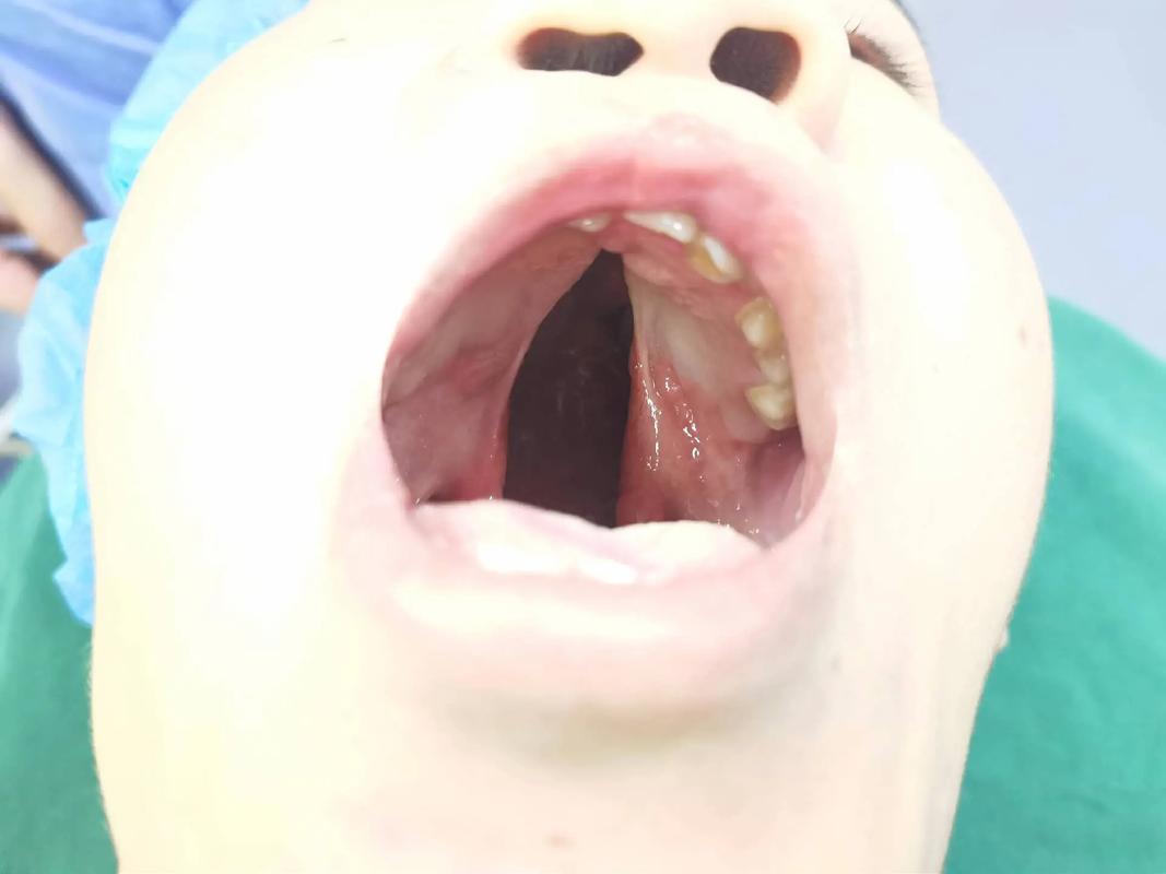 口腔正畸 唇腭裂-图2