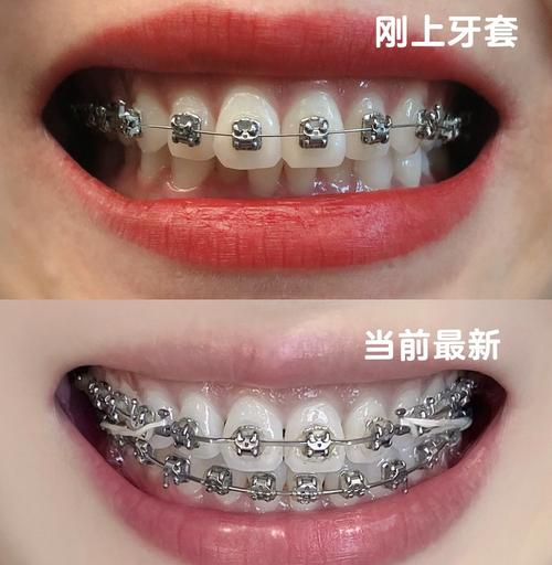 普通金属钢丝正畸-图3