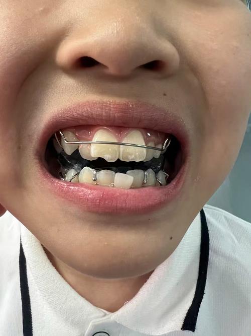 正畸儿童早期矫正-图2