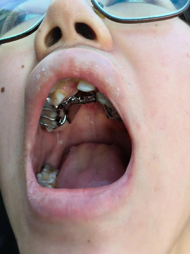 龅牙拔牙正畸视频-图3 龅牙拔牙正畸视频-图3