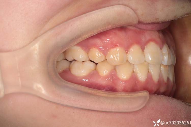 龅牙拔牙正畸视频-图2 龅牙拔牙正畸视频-图2