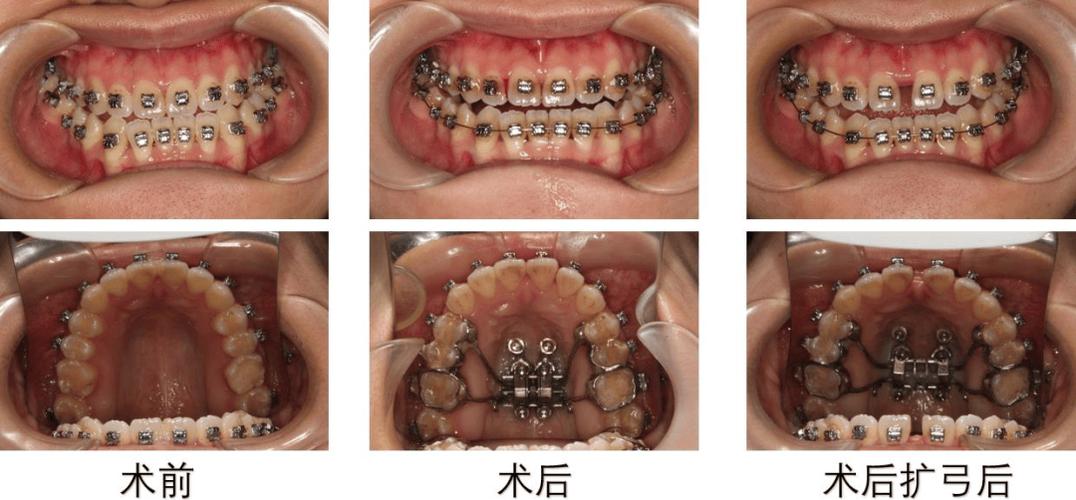 正畸牵引调整中缝-图2 正畸牵引调整中缝-图2