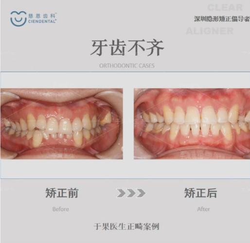 深圳口腔牙齿正畸-图2 深圳口腔牙齿正畸-图2
