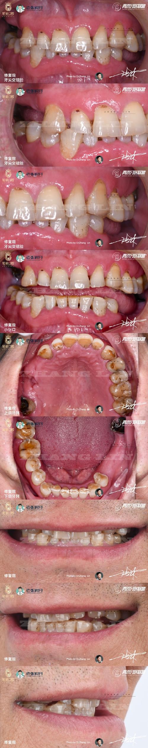 咬合重建等同于正畸吗？二者真的一样吗？-图2