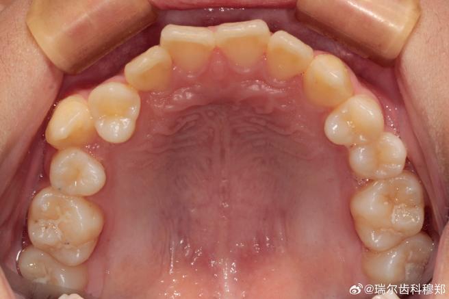 隐形正畸中线不齐是什么原因导致的？怎么解决比较好？-图3