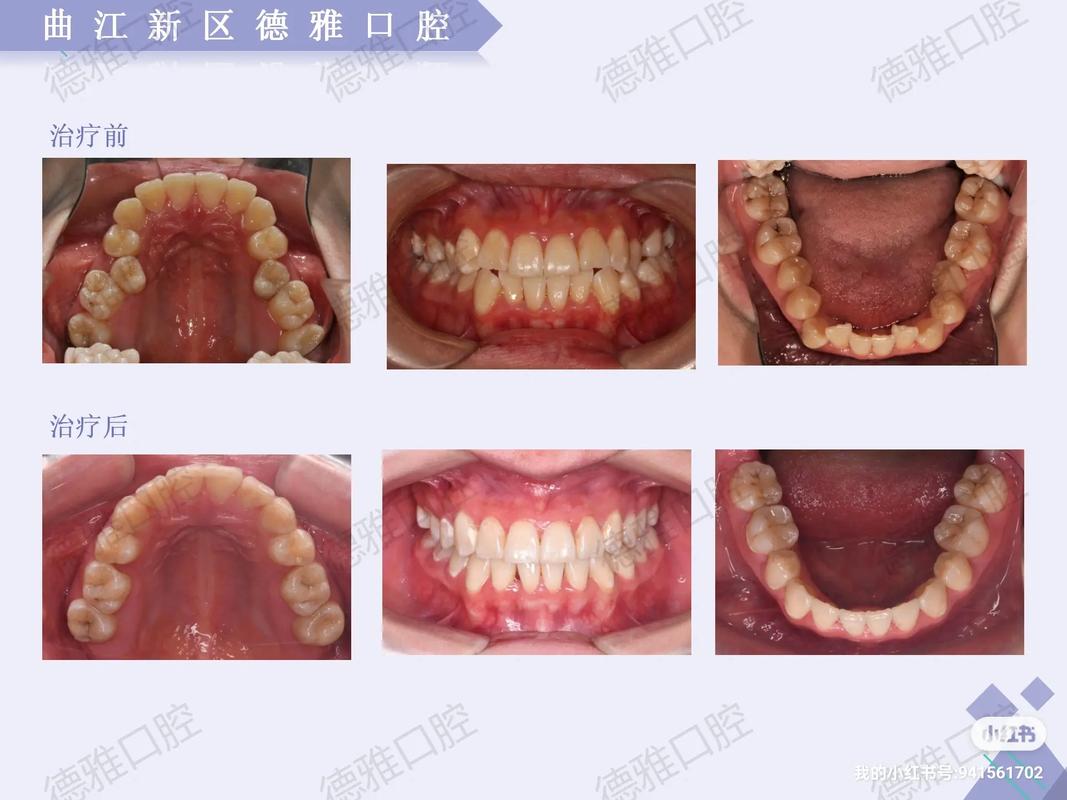 口腔正畸病例视频效果如何?看完能改善牙齿吗?-图3 口腔正畸病例视频效果如何?看完能改善牙齿吗?-图3