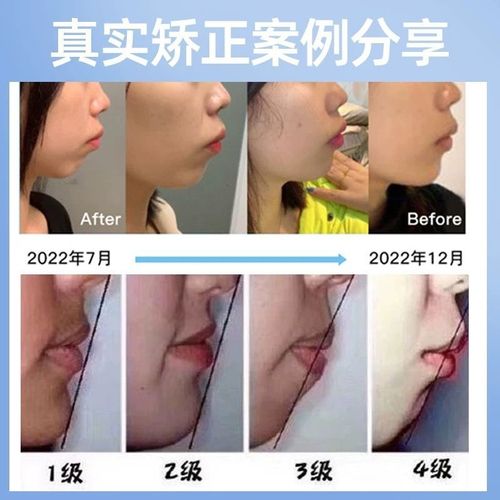 正畸治疗会影响颞下颌关节健康吗？-图2