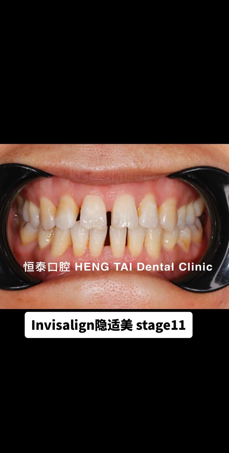 美国牙齿成人正畸-图3