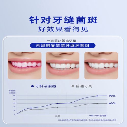 成人正畸牙齿清洁，如何做到有效清洁？-图1