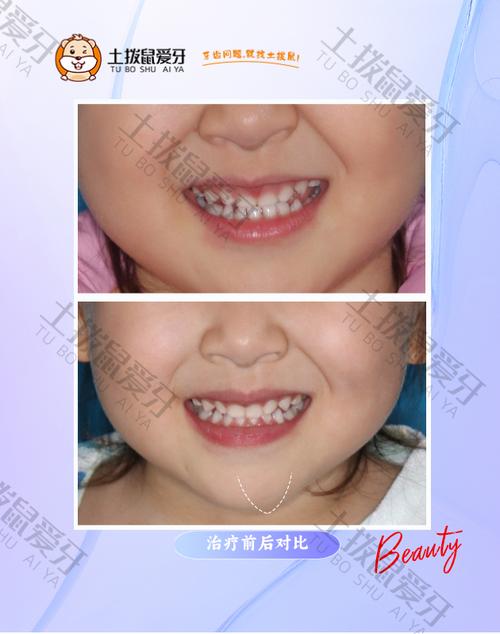正畸时有乳牙,会影响牙齿矫正效果吗?-图1 正畸时有乳牙,会影响牙齿矫正效果吗?-图1
