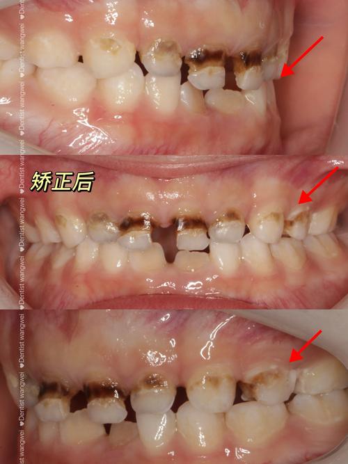 正畸时有乳牙,会影响牙齿矫正效果吗?-图2 正畸时有乳牙,会影响牙齿矫正效果吗?-图2