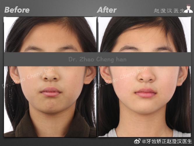 正畸牙齿缺失病例-图2 正畸牙齿缺失病例-图2